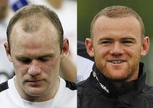 Hair-transplant-Wayne-Rooney-e1506137677910